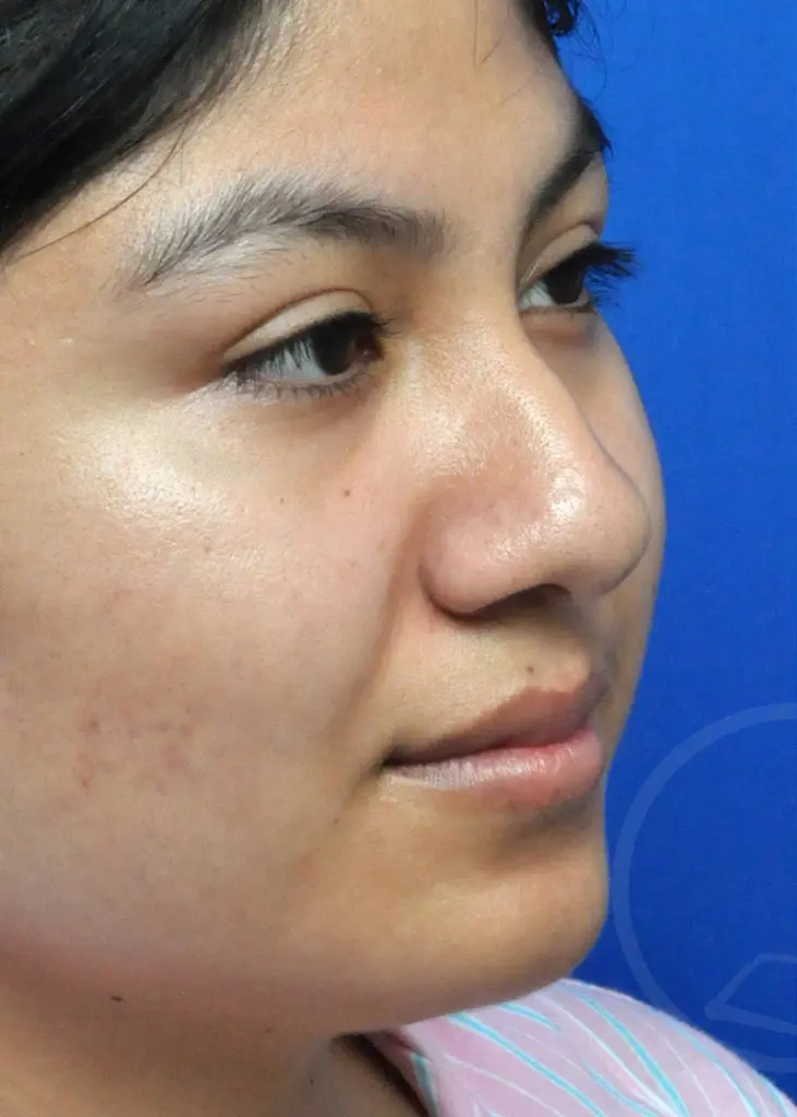 Plastic Surgery Before and After Pictures in Jacksonville, FL - Garcia Facial Plastic Surgery