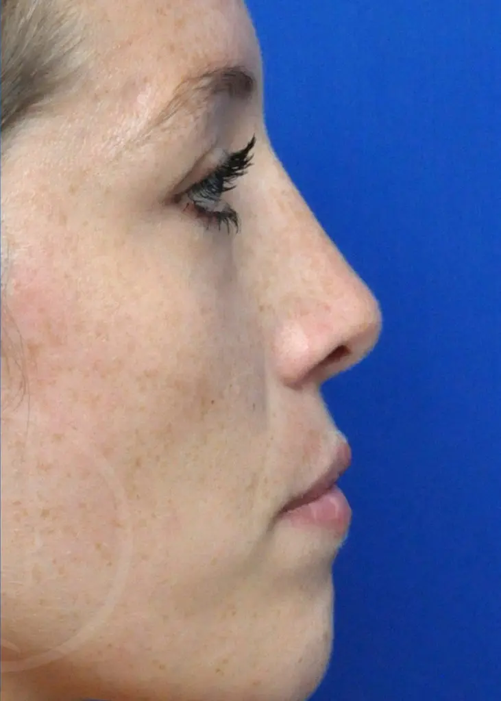Plastic Surgery Before and After Pictures in Jacksonville, FL - Garcia Facial Plastic Surgery