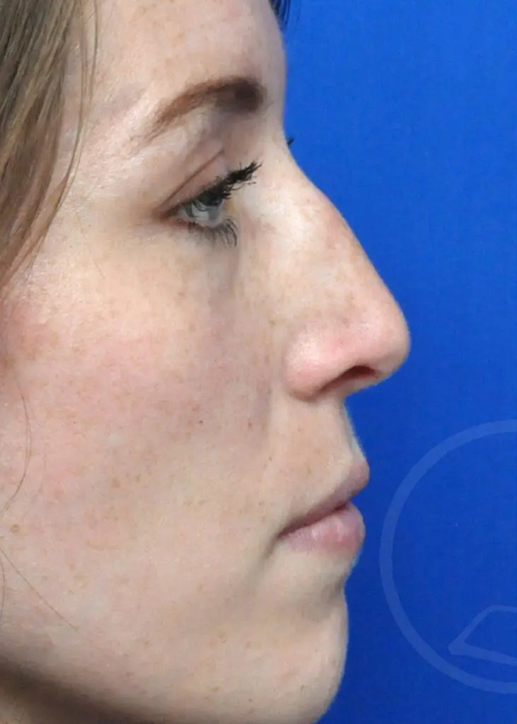 Plastic Surgery Before and After Pictures in Jacksonville, FL - Garcia Facial Plastic Surgery