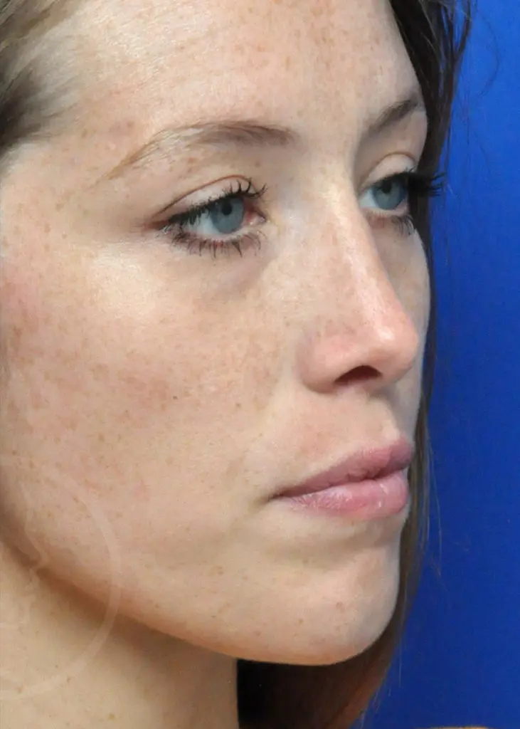 Plastic Surgery Before and After Pictures in Jacksonville, FL - Garcia Facial Plastic Surgery