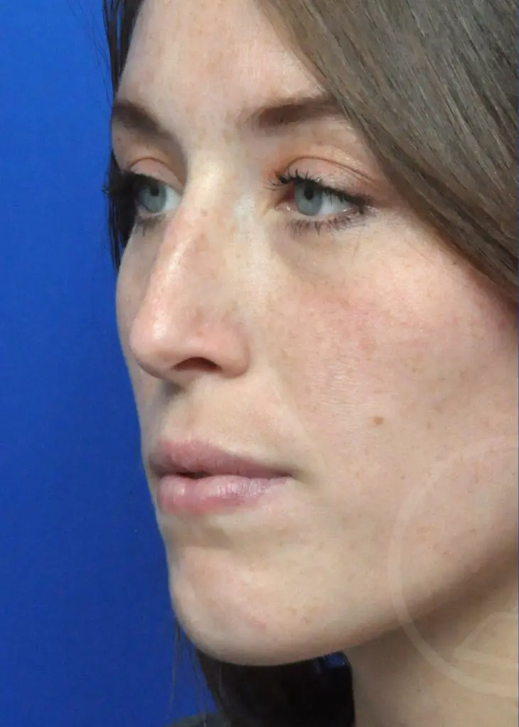 Plastic Surgery Before and After Pictures in Jacksonville, FL - Garcia Facial Plastic Surgery