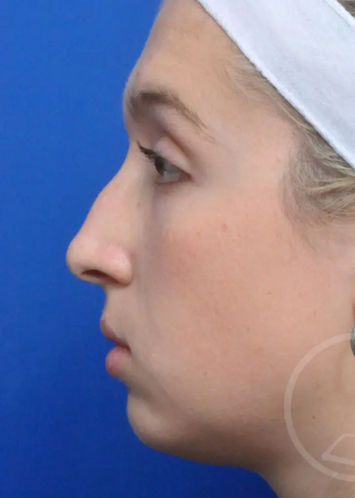 Plastic Surgery Before and After Pictures in Jacksonville, FL - Garcia Facial Plastic Surgery