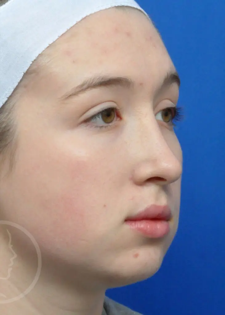 Plastic Surgery Before and After Pictures in Jacksonville, FL - Garcia Facial Plastic Surgery