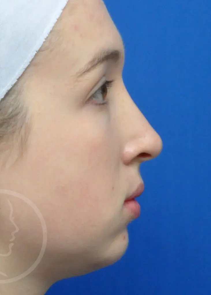 Plastic Surgery Before and After Pictures in Jacksonville, FL - Garcia Facial Plastic Surgery
