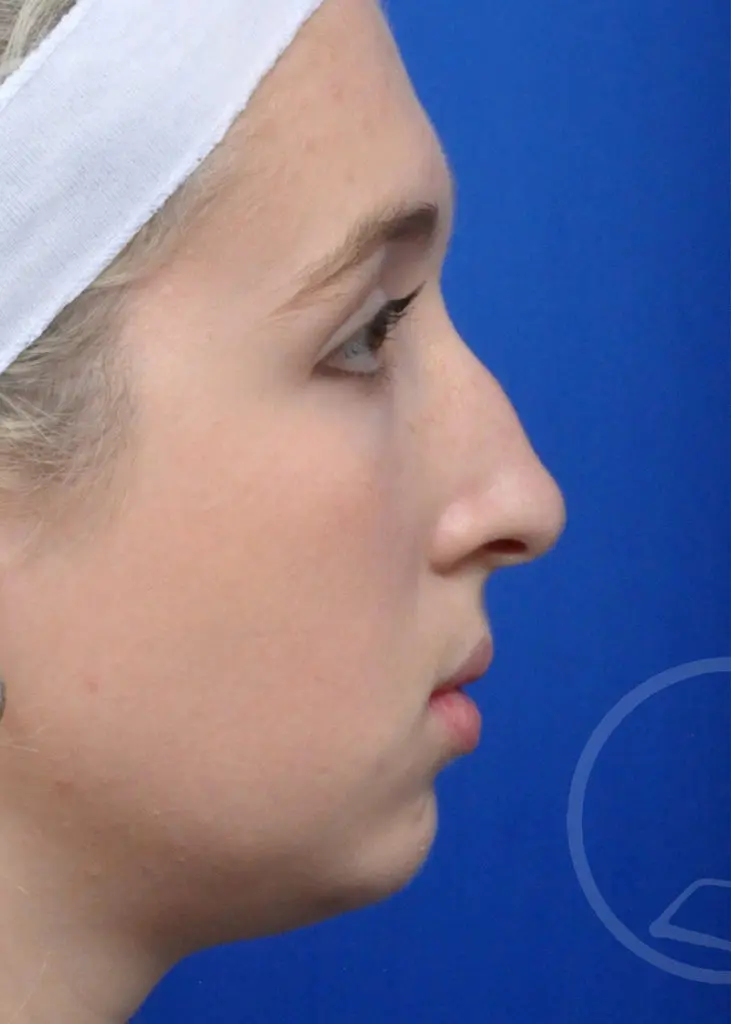 Plastic Surgery Before and After Pictures in Jacksonville, FL - Garcia Facial Plastic Surgery