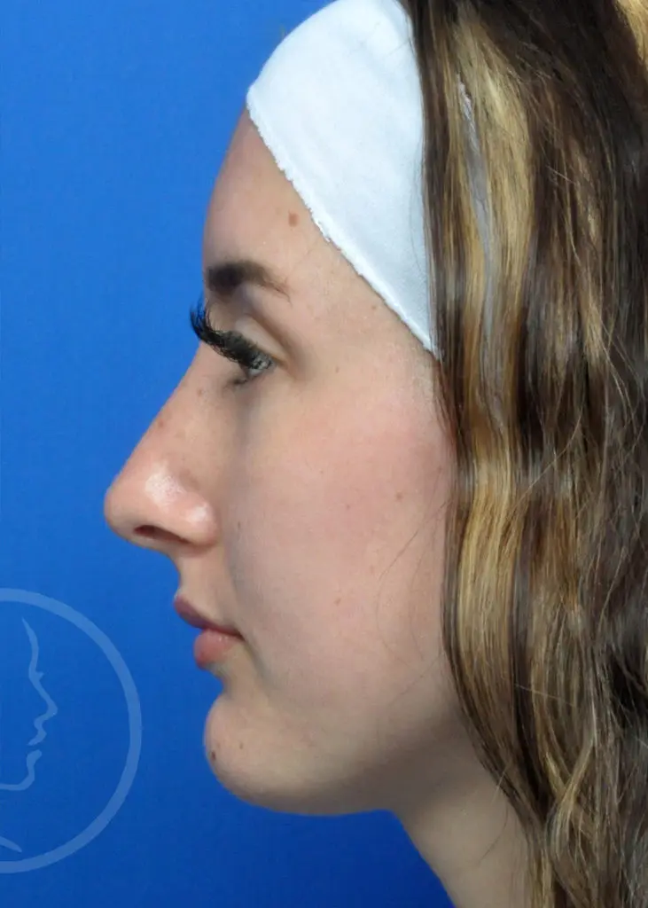 Plastic Surgery Before and After Pictures in Jacksonville, FL - Garcia Facial Plastic Surgery