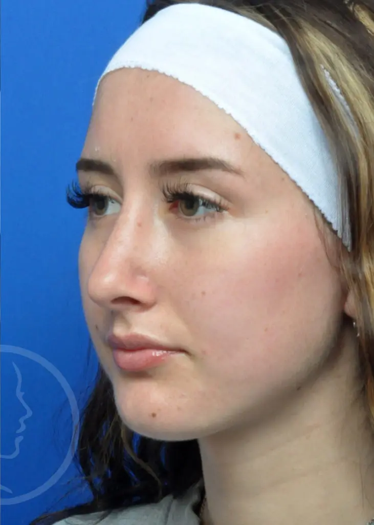 Plastic Surgery Before and After Pictures in Jacksonville, FL - Garcia Facial Plastic Surgery