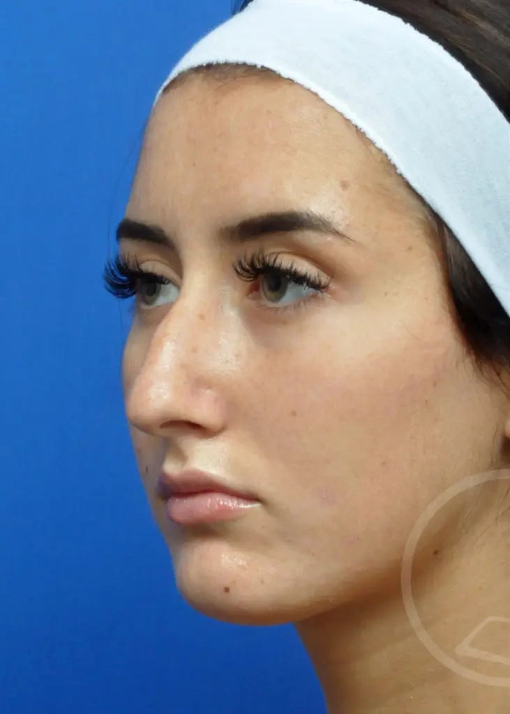 Plastic Surgery Before and After Pictures in Jacksonville, FL - Garcia Facial Plastic Surgery