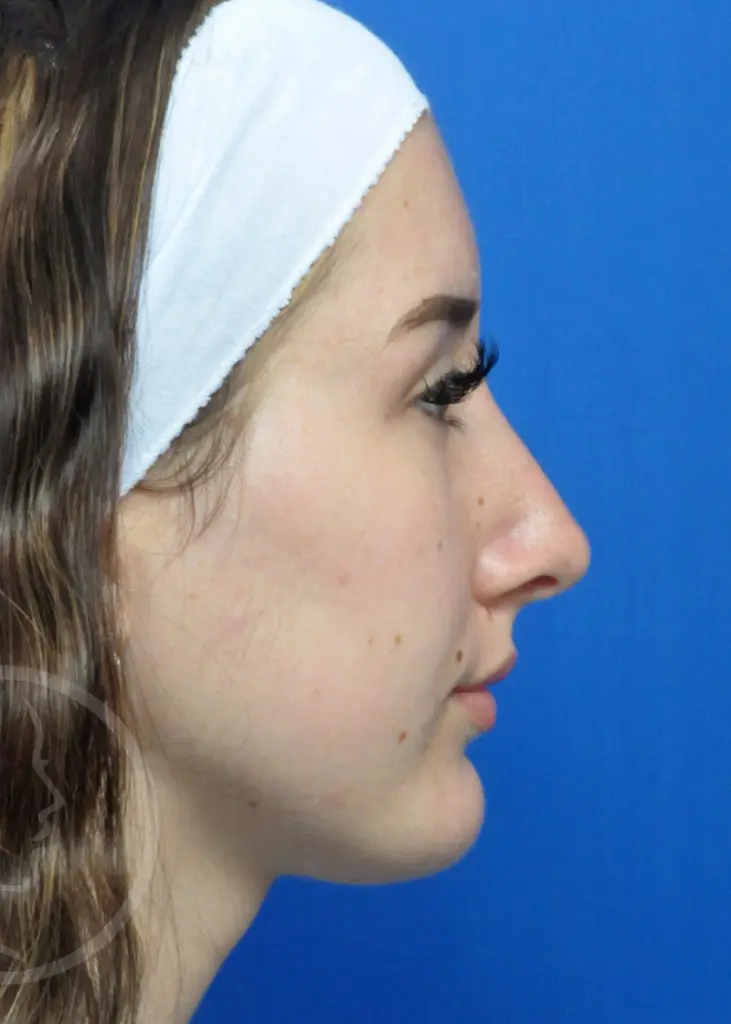 Plastic Surgery Before and After Pictures in Jacksonville, FL - Garcia Facial Plastic Surgery