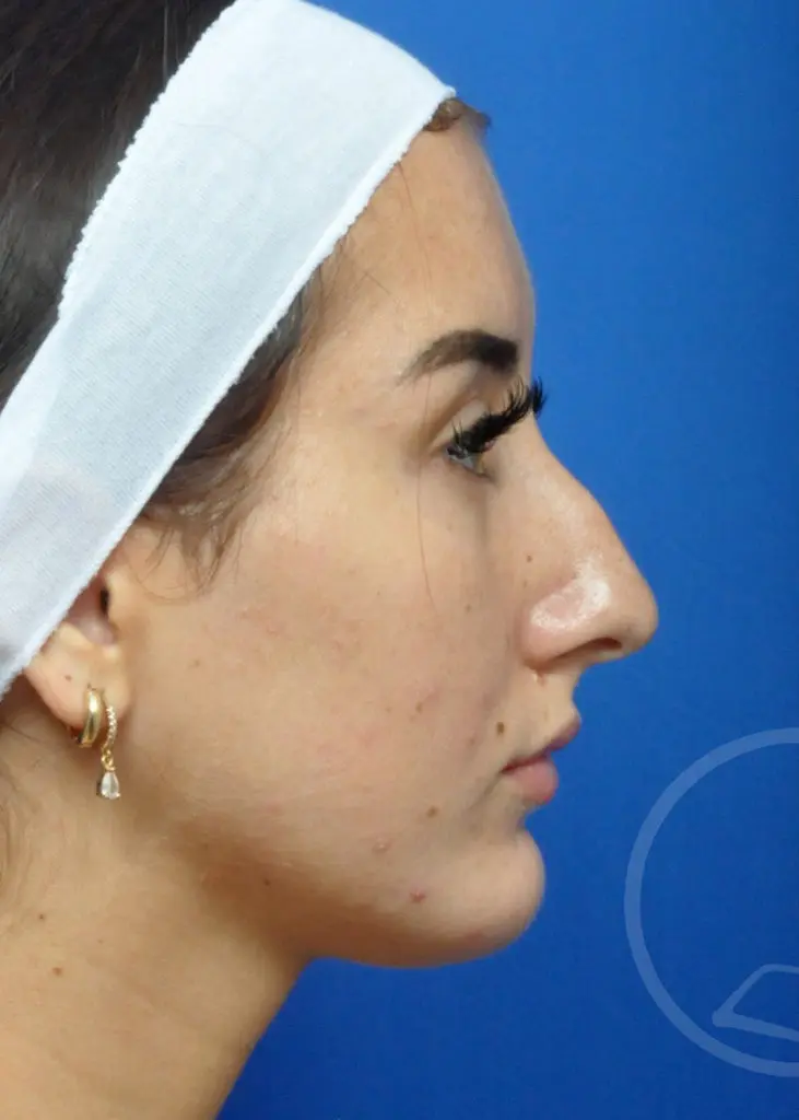 Plastic Surgery Before and After Pictures in Jacksonville, FL - Garcia Facial Plastic Surgery