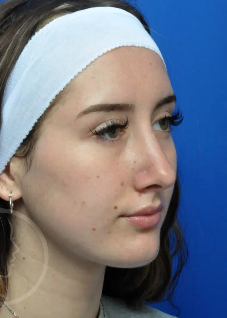 Plastic Surgery Before and After Pictures in Jacksonville, FL - Garcia Facial Plastic Surgery