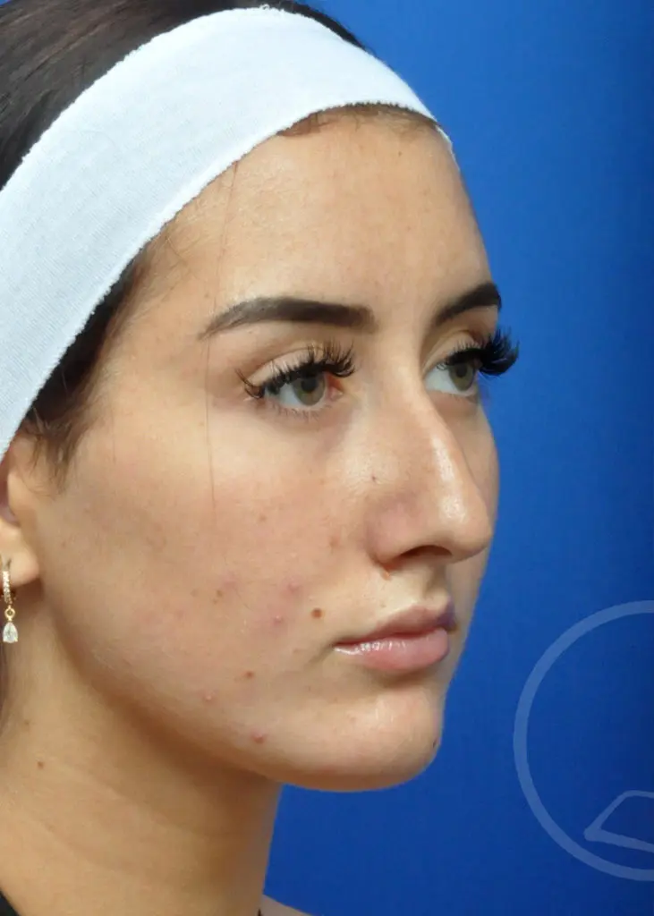 Plastic Surgery Before and After Pictures in Jacksonville, FL - Garcia Facial Plastic Surgery