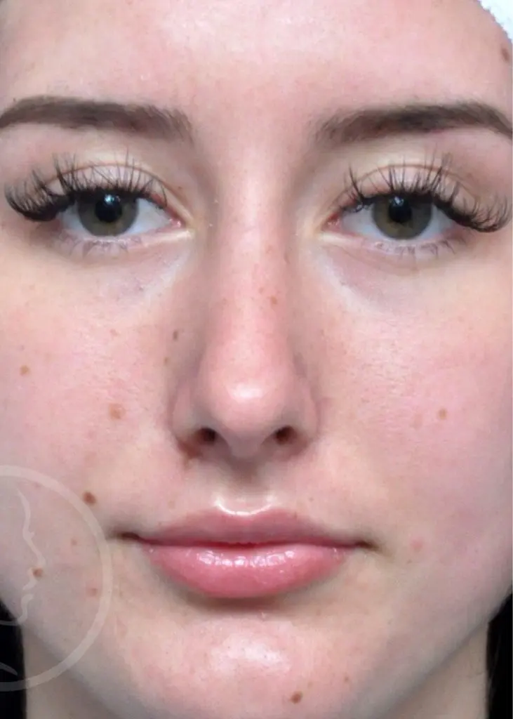 Plastic Surgery Before and After Pictures in Jacksonville, FL - Garcia Facial Plastic Surgery