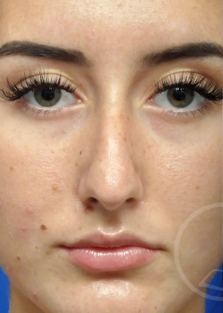 Plastic Surgery Before and After Pictures in Jacksonville, FL - Garcia Facial Plastic Surgery