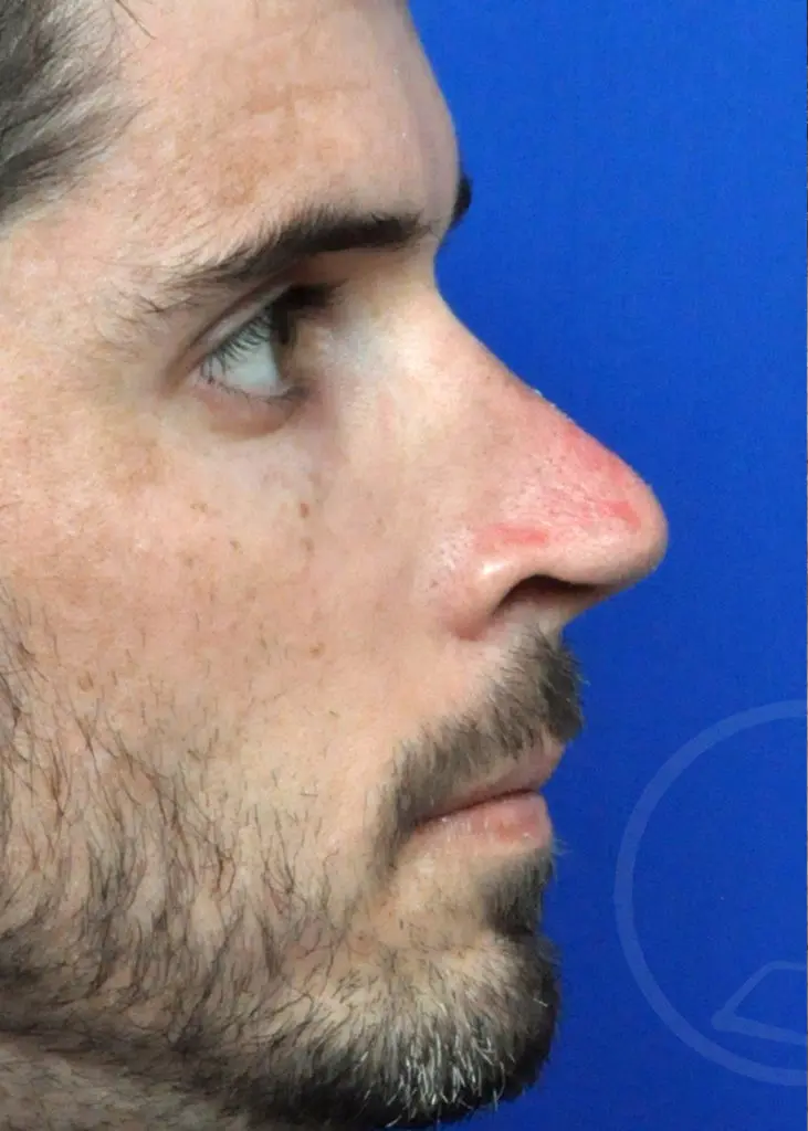 Plastic Surgery Before and After Pictures in Jacksonville, FL - Garcia Facial Plastic Surgery