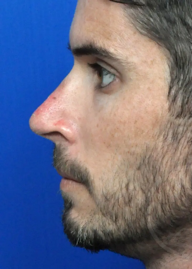 Plastic Surgery Before and After Pictures in Jacksonville, FL - Garcia Facial Plastic Surgery