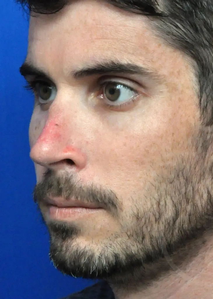 Plastic Surgery Before and After Pictures in Jacksonville, FL - Garcia Facial Plastic Surgery