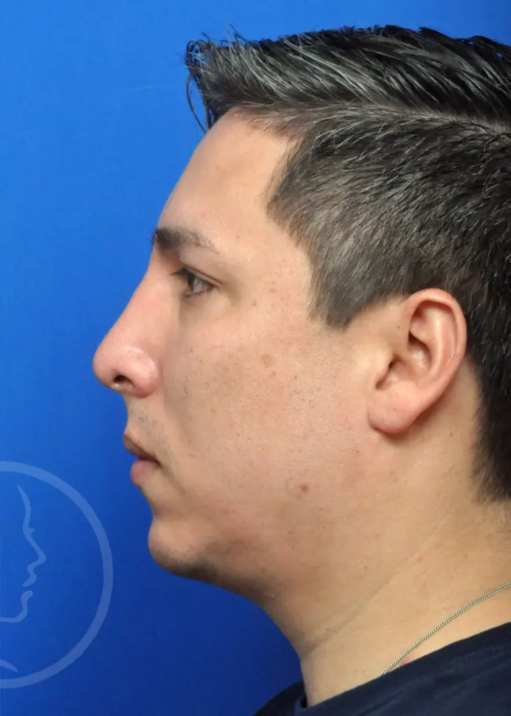 Plastic Surgery Before and After Pictures in Jacksonville, FL - Garcia Facial Plastic Surgery