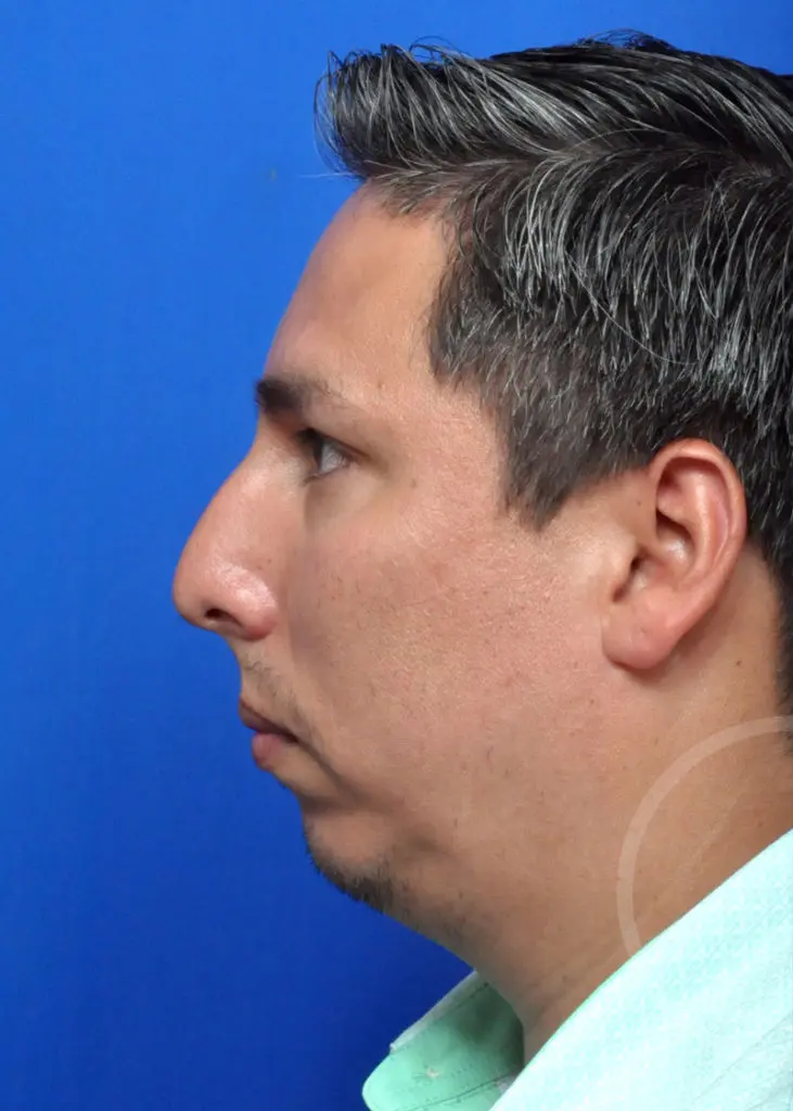 Plastic Surgery Before and After Pictures in Jacksonville, FL - Garcia Facial Plastic Surgery