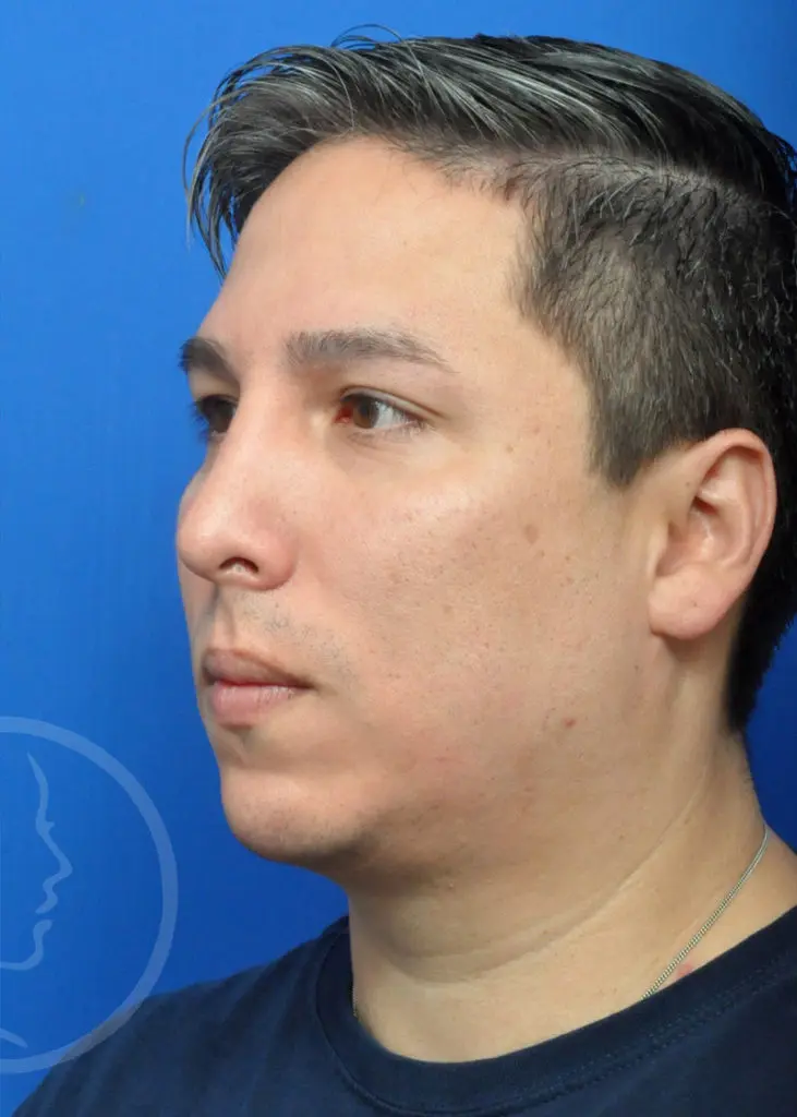 Plastic Surgery Before and After Pictures in Jacksonville, FL - Garcia Facial Plastic Surgery