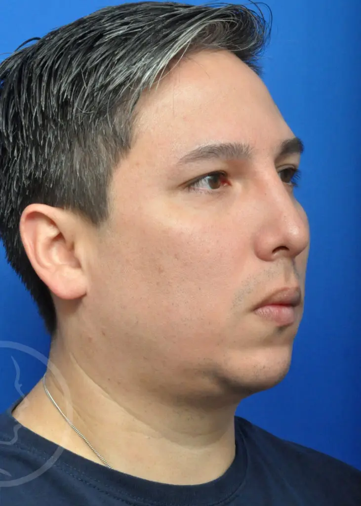 Plastic Surgery Before and After Pictures in Jacksonville, FL - Garcia Facial Plastic Surgery