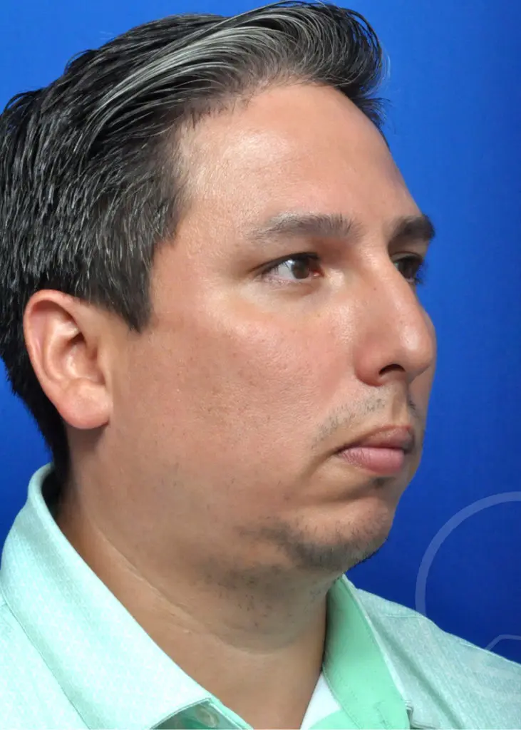 Plastic Surgery Before and After Pictures in Jacksonville, FL - Garcia Facial Plastic Surgery