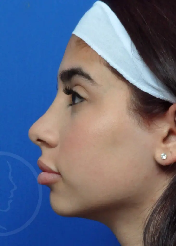 Plastic Surgery Before and After Pictures in Jacksonville, FL - Garcia Facial Plastic Surgery