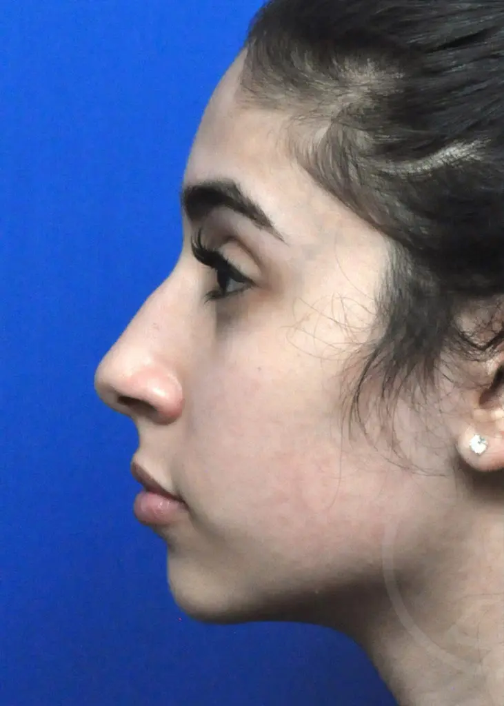 Plastic Surgery Before and After Pictures in Jacksonville, FL - Garcia Facial Plastic Surgery