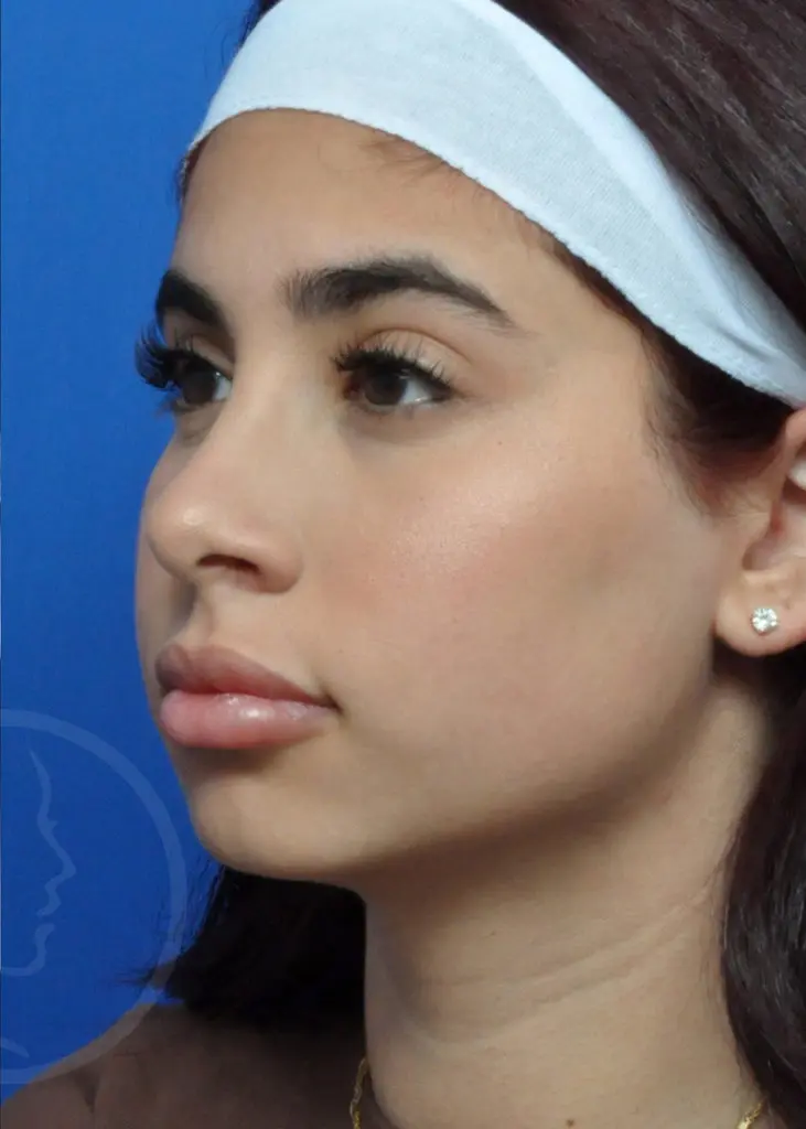 Plastic Surgery Before and After Pictures in Jacksonville, FL - Garcia Facial Plastic Surgery