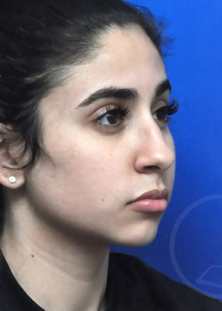 Plastic Surgery Before and After Pictures in Jacksonville, FL - Garcia Facial Plastic Surgery