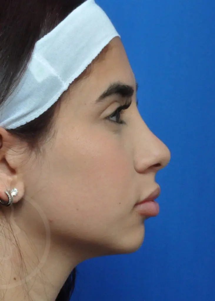 Plastic Surgery Before and After Pictures in Jacksonville, FL - Garcia Facial Plastic Surgery