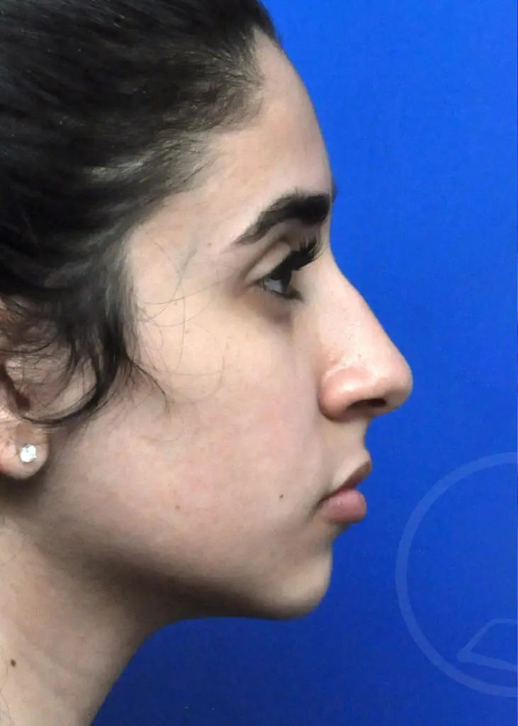 Plastic Surgery Before and After Pictures in Jacksonville, FL - Garcia Facial Plastic Surgery