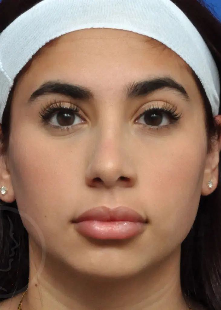 Plastic Surgery Before and After Pictures in Jacksonville, FL - Garcia Facial Plastic Surgery