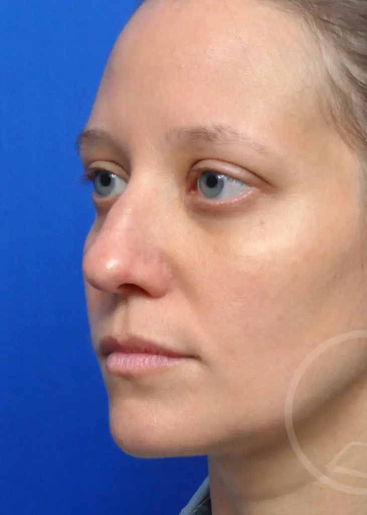 Plastic Surgery Before and After Pictures in Jacksonville, FL - Garcia Facial Plastic Surgery