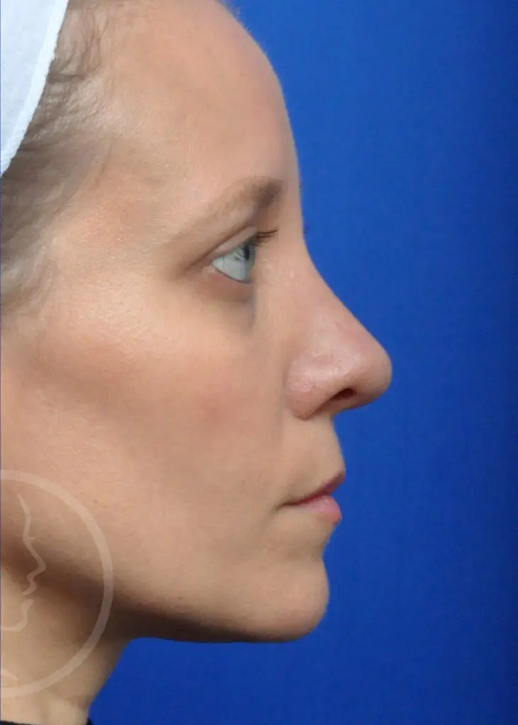 Plastic Surgery Before and After Pictures in Jacksonville, FL - Garcia Facial Plastic Surgery