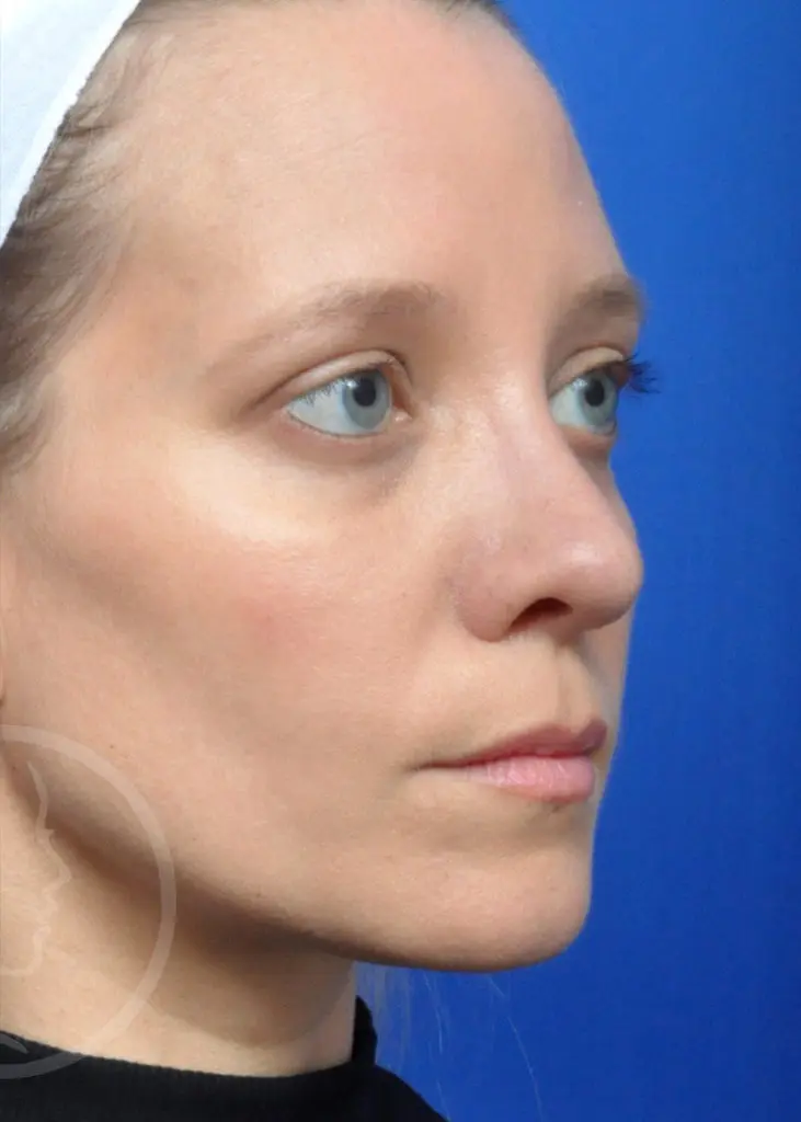 Plastic Surgery Before and After Pictures in Jacksonville, FL - Garcia Facial Plastic Surgery