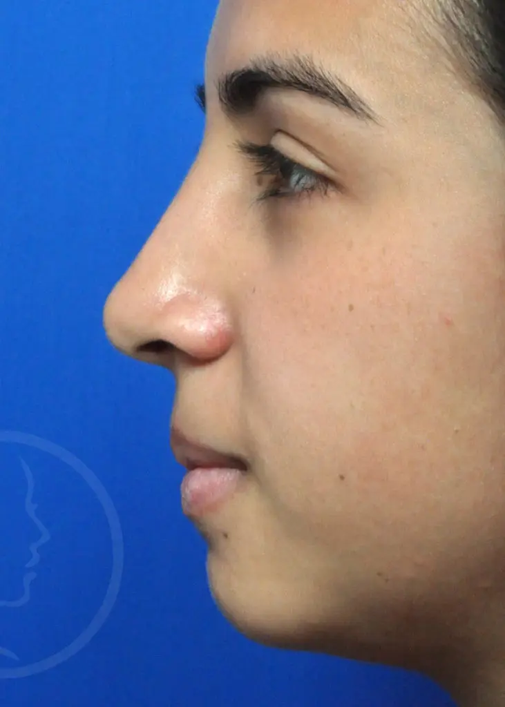 Plastic Surgery Before and After Pictures in Jacksonville, FL - Garcia Facial Plastic Surgery