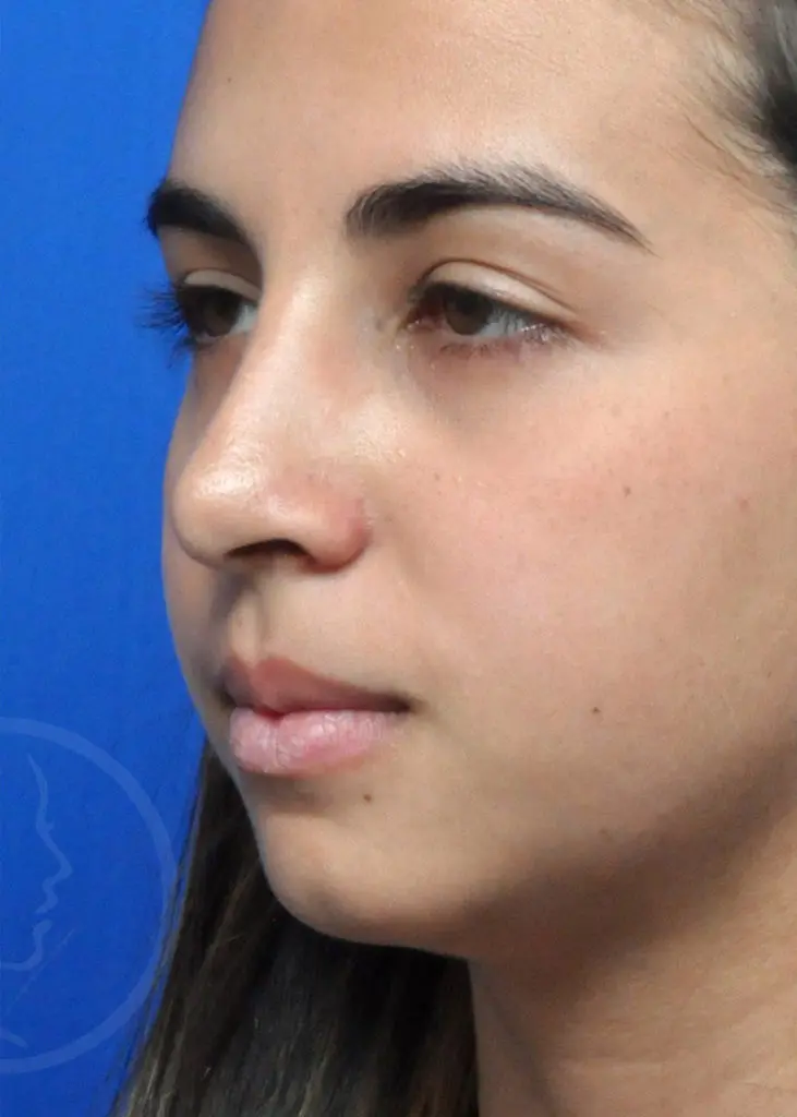 Plastic Surgery Before and After Pictures in Jacksonville, FL - Garcia Facial Plastic Surgery
