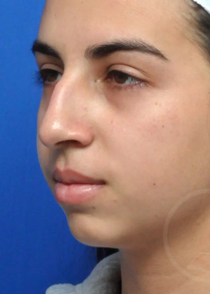 Plastic Surgery Before and After Pictures in Jacksonville, FL - Garcia Facial Plastic Surgery