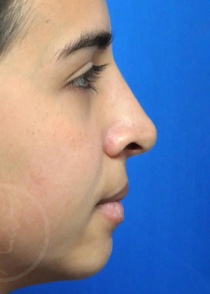 Plastic Surgery Before and After Pictures in Jacksonville, FL - Garcia Facial Plastic Surgery