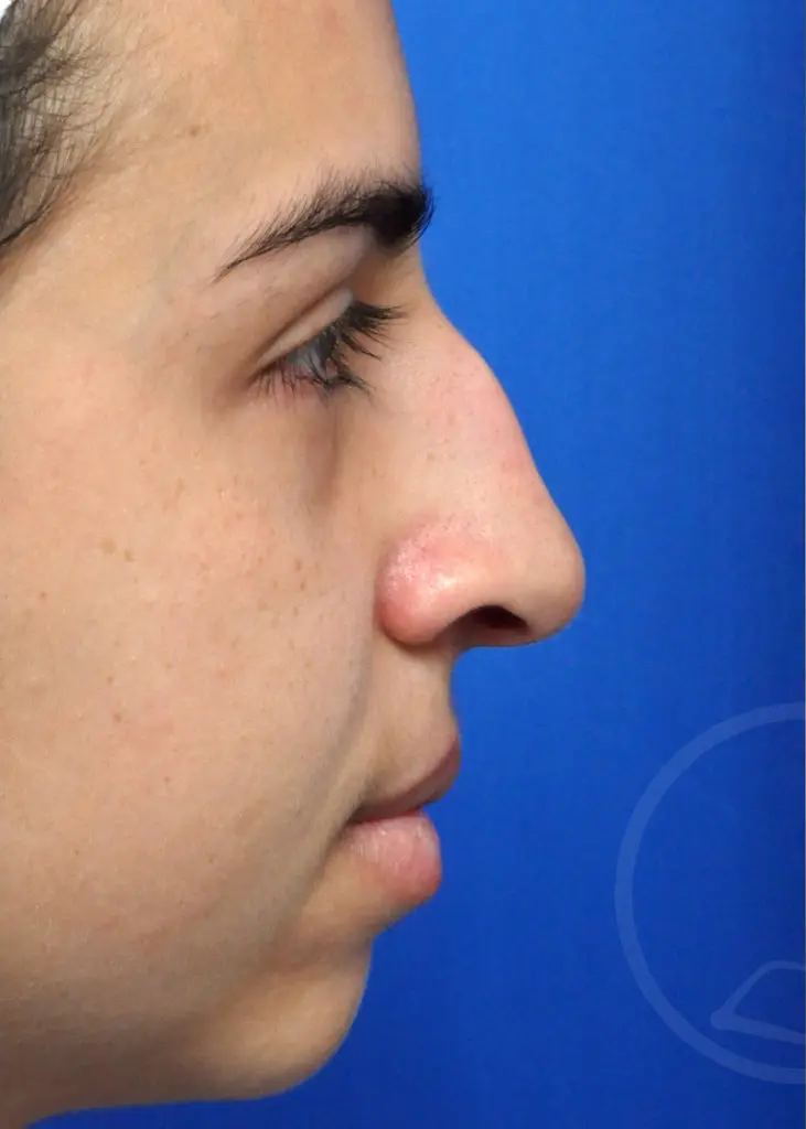 Plastic Surgery Before and After Pictures in Jacksonville, FL - Garcia Facial Plastic Surgery
