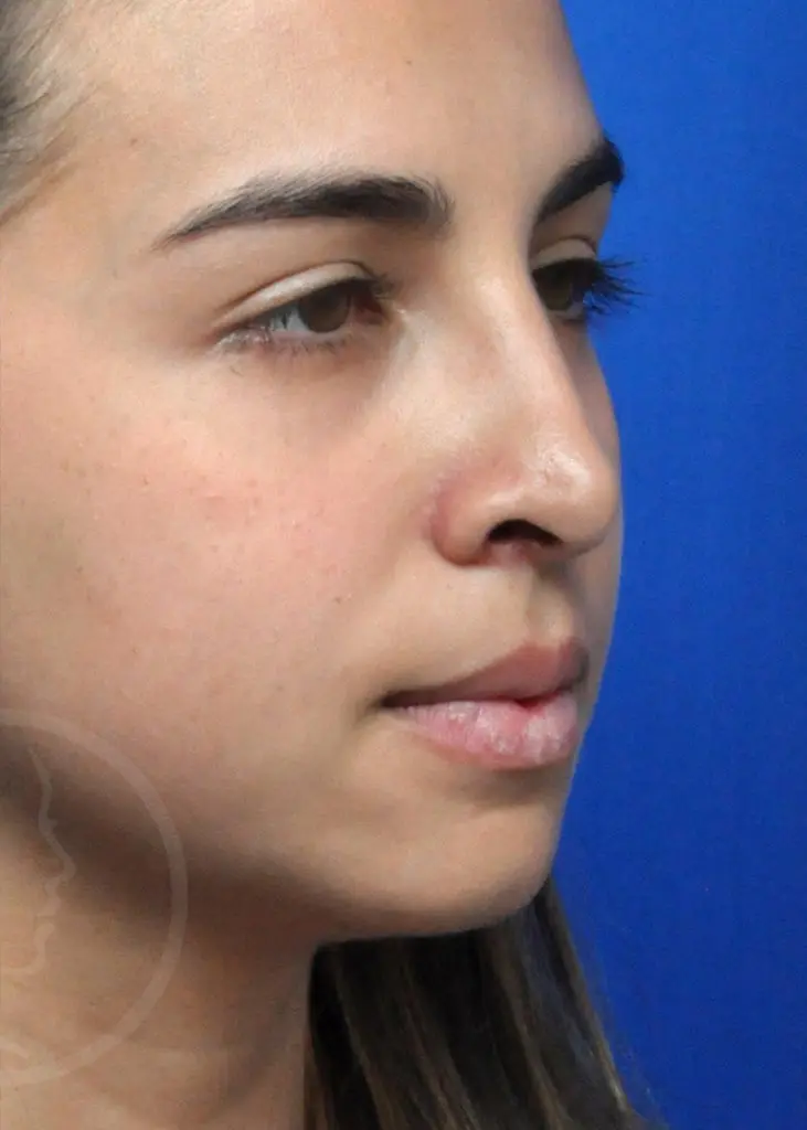 Plastic Surgery Before and After Pictures in Jacksonville, FL - Garcia Facial Plastic Surgery