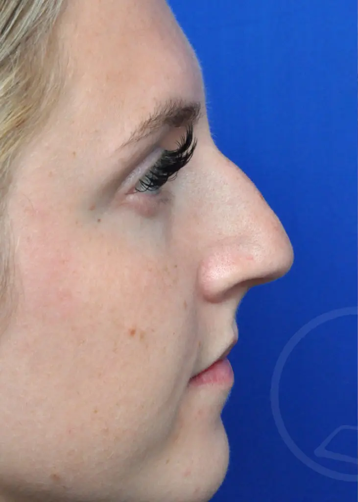 Plastic Surgery Before and After Pictures in Jacksonville, FL - Garcia Facial Plastic Surgery