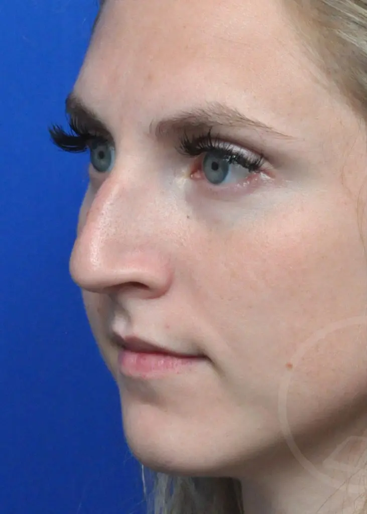 Plastic Surgery Before and After Pictures in Jacksonville, FL - Garcia Facial Plastic Surgery