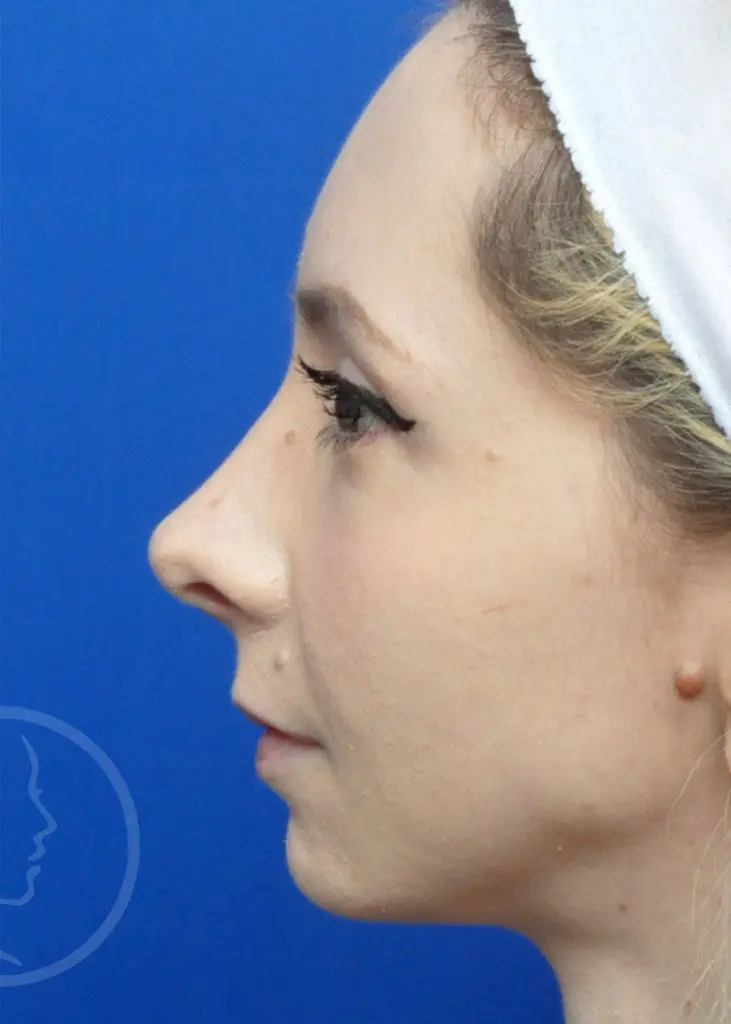 Plastic Surgery Before and After Pictures in Jacksonville, FL - Garcia Facial Plastic Surgery