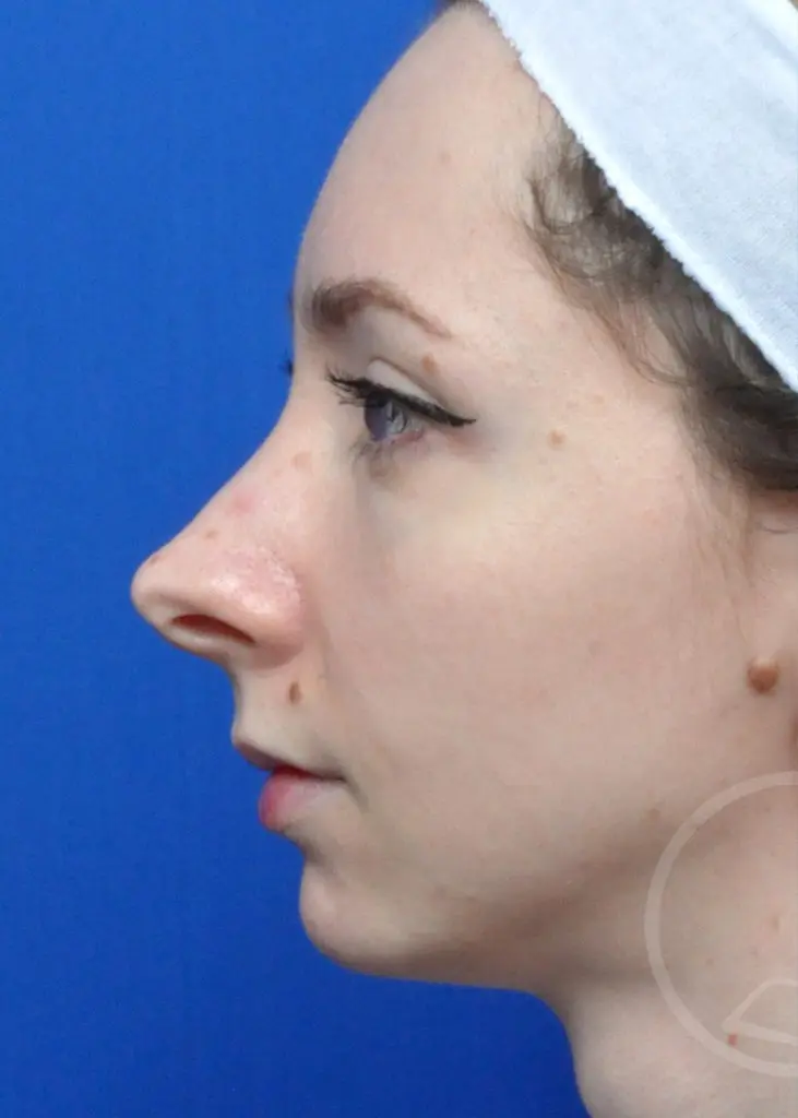 Plastic Surgery Before and After Pictures in Jacksonville, FL - Garcia Facial Plastic Surgery