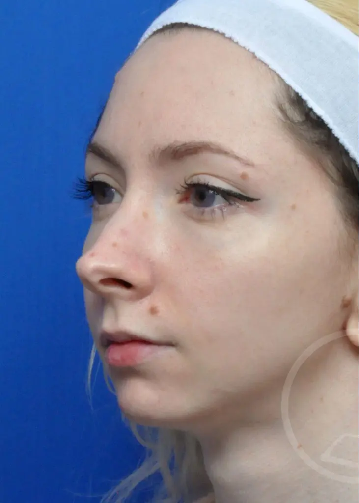 Plastic Surgery Before and After Pictures in Jacksonville, FL - Garcia Facial Plastic Surgery