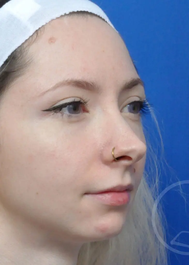 Plastic Surgery Before and After Pictures in Jacksonville, FL - Garcia Facial Plastic Surgery