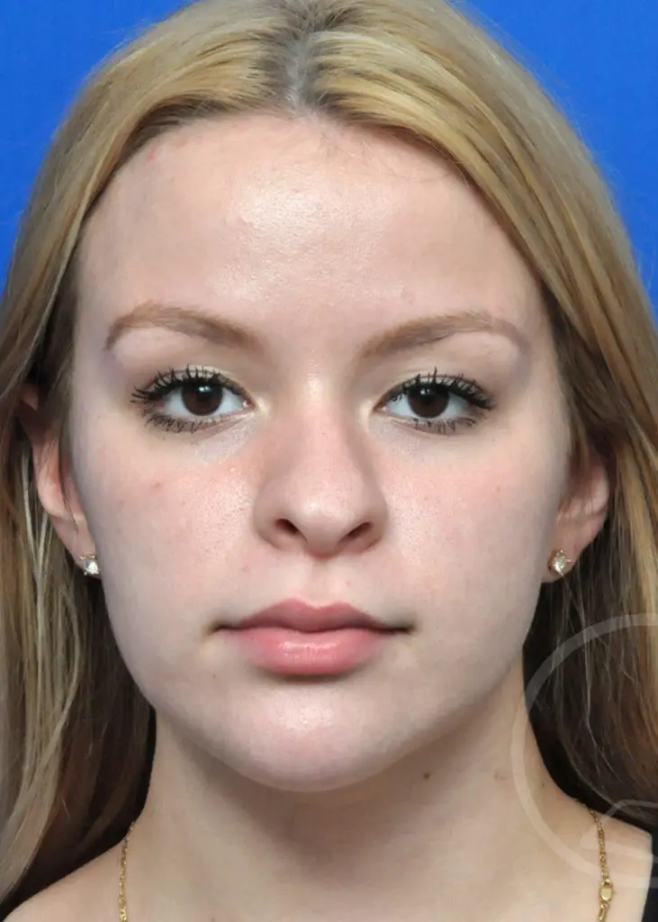 Plastic Surgery Before and After Pictures in Jacksonville, FL - Garcia Facial Plastic Surgery