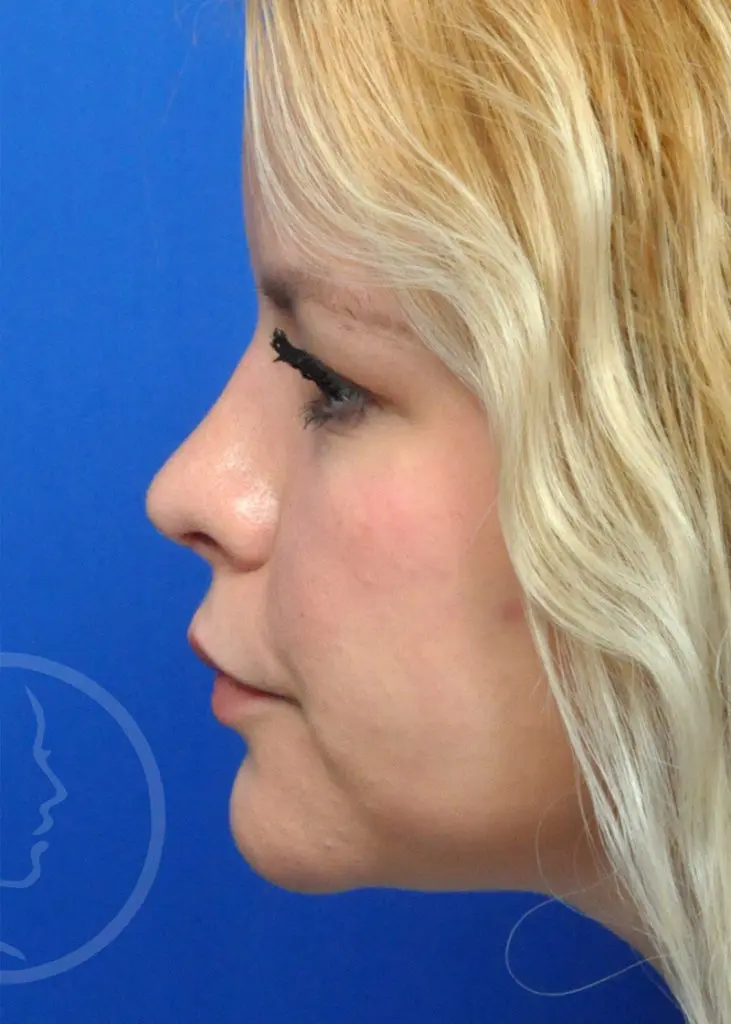 Plastic Surgery Before and After Pictures in Jacksonville, FL - Garcia Facial Plastic Surgery